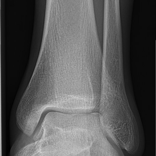 Ankle X-ray