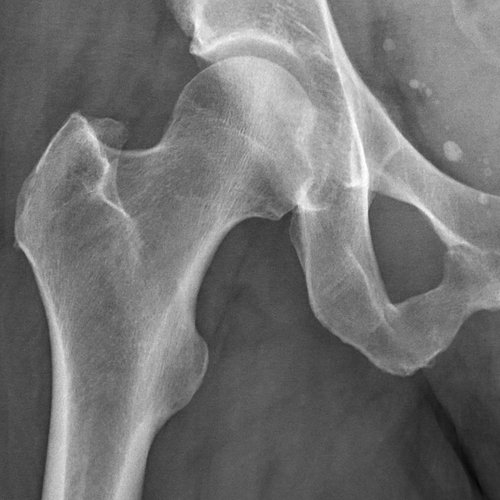 Hip and pelvis X-ray