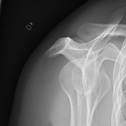 Shoulder X-ray